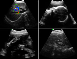 ultrasound linear probe